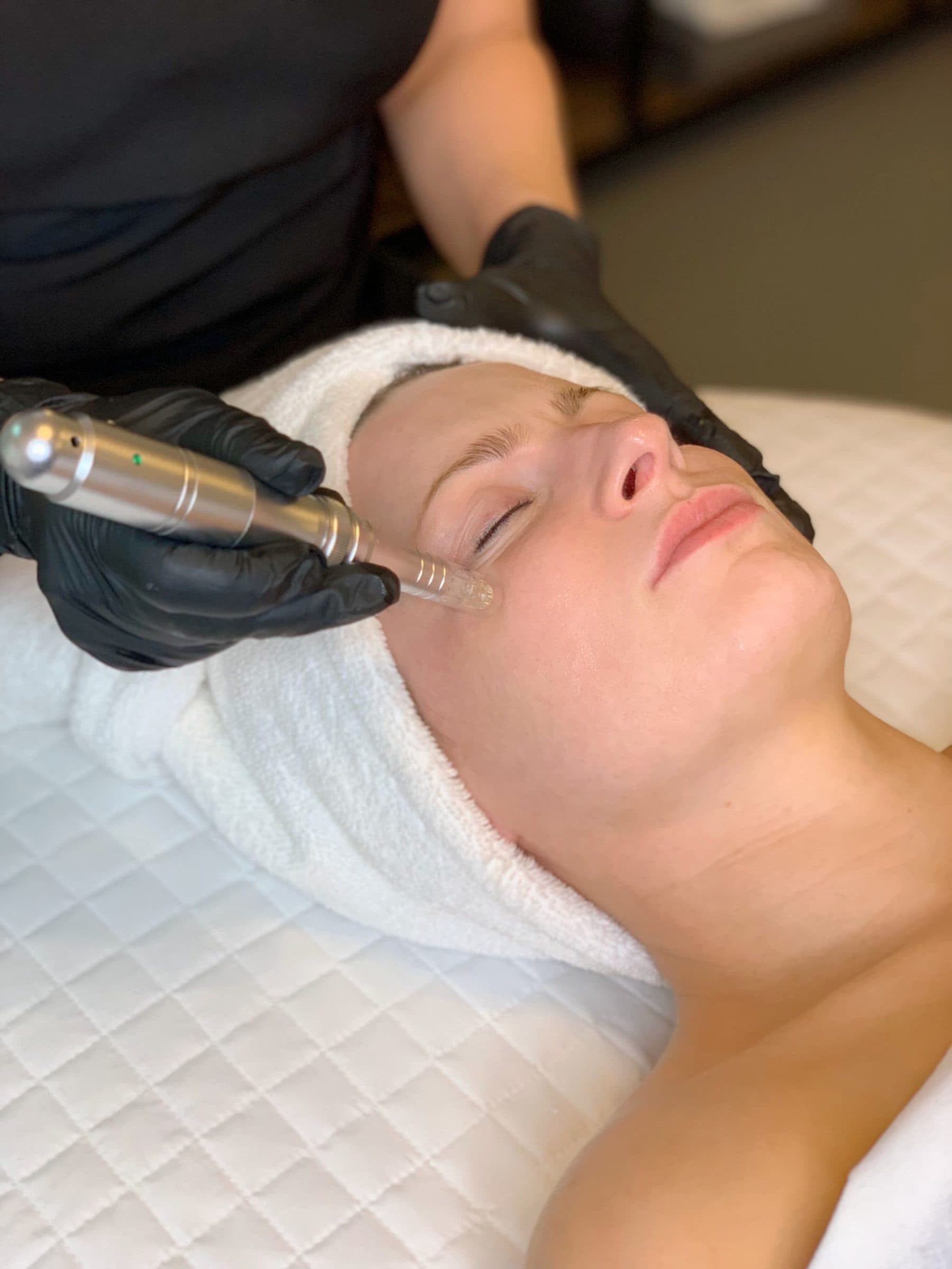 Microneedling