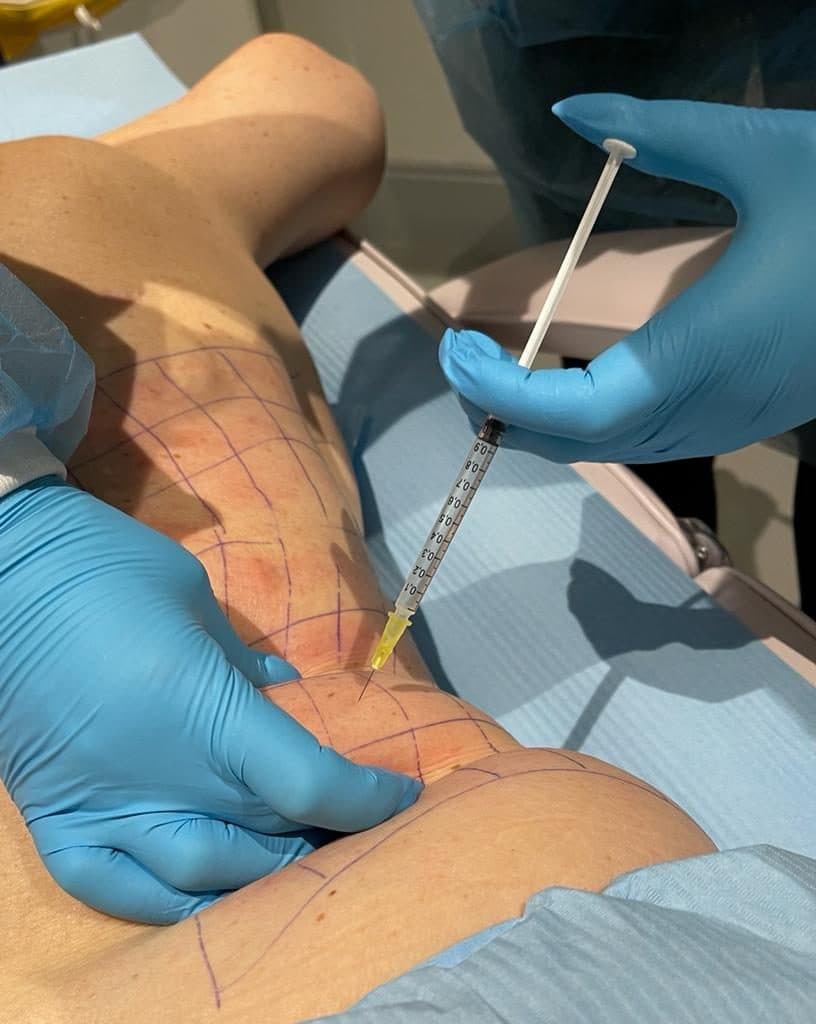 Fat Dissolving Injections