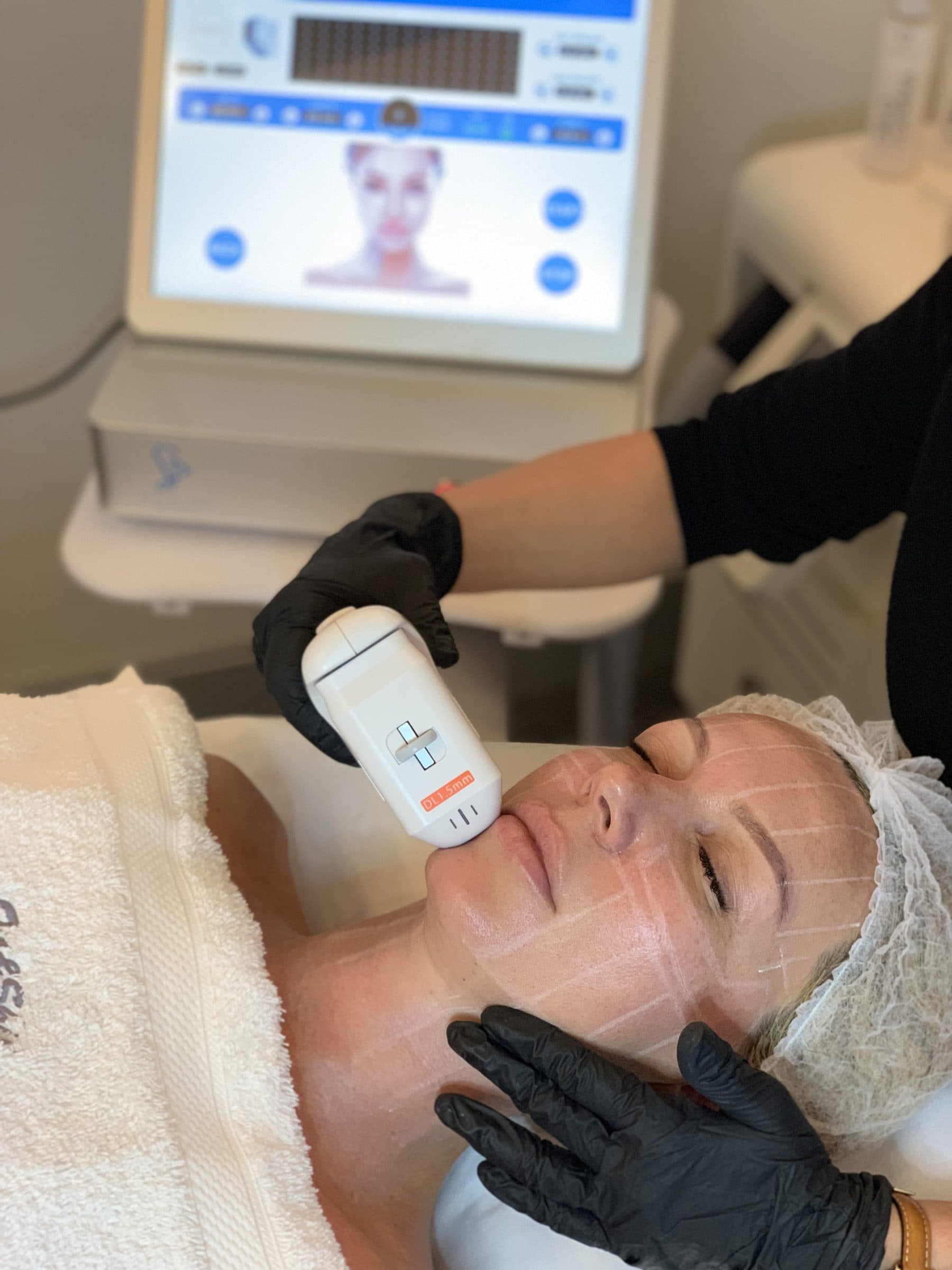 HIFU Facial