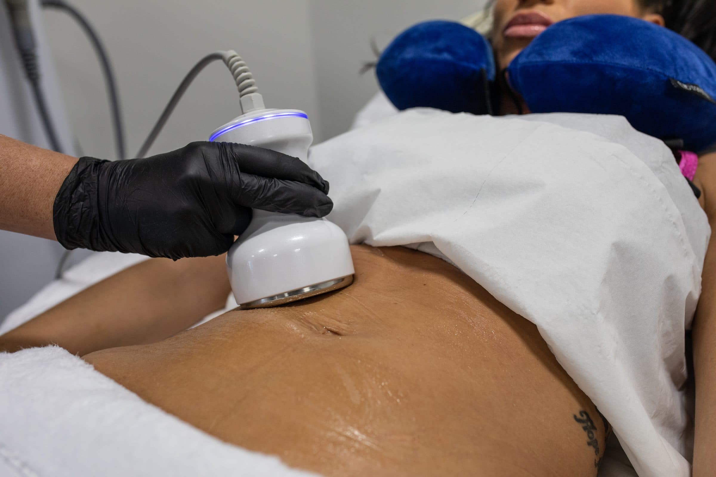 Ultrasound Cavitation
