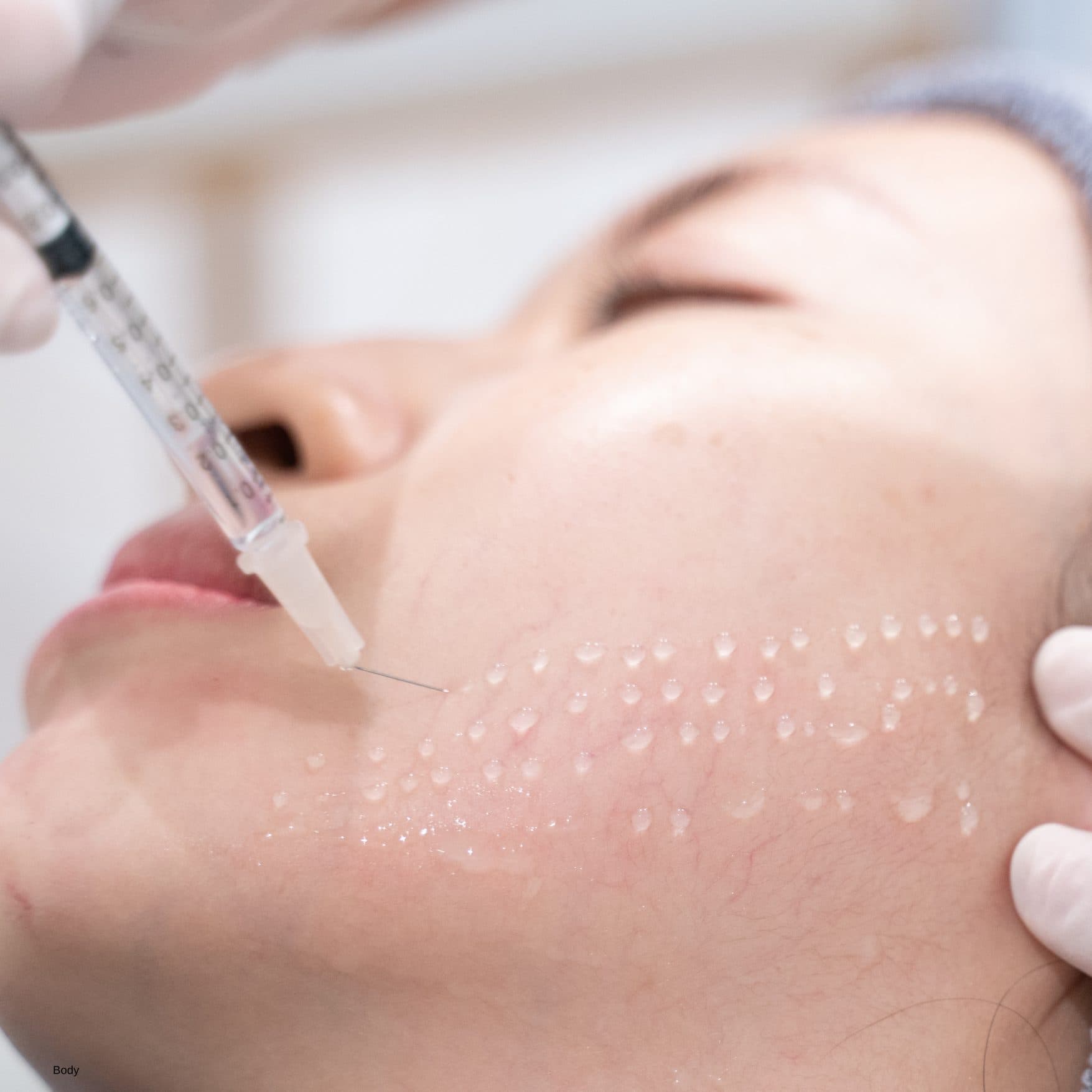 Mesotherapy