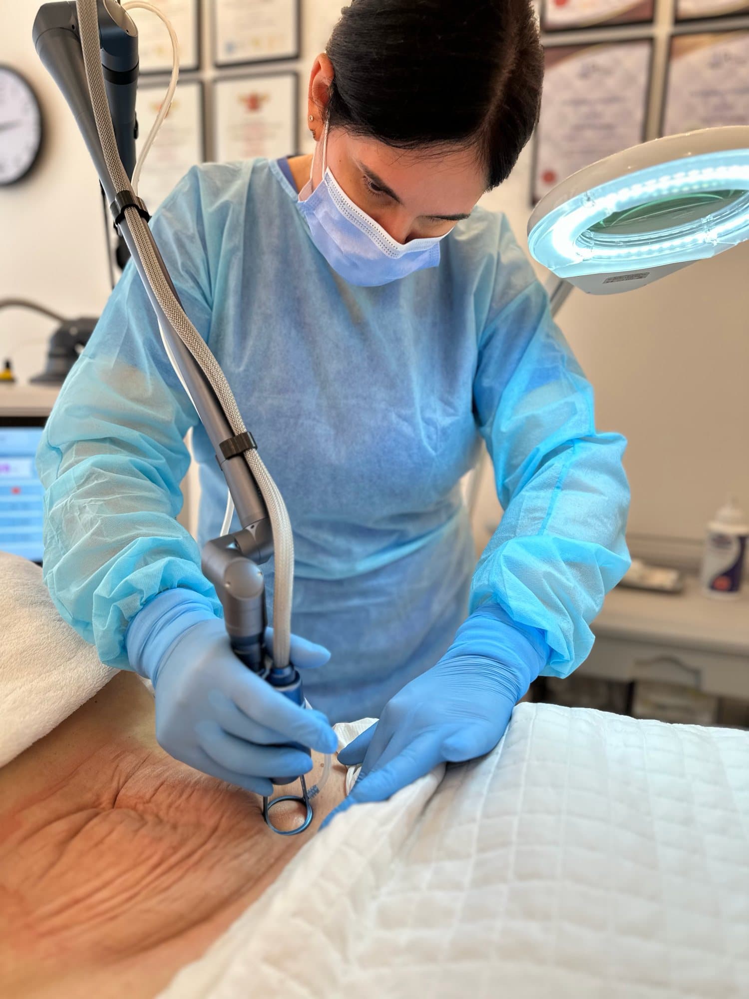 Fractional CO2 Laser